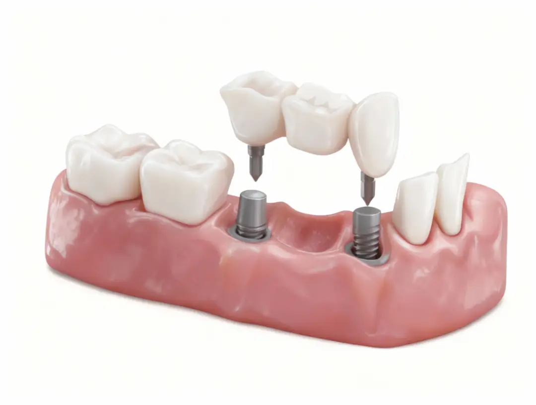 Dental Bridges-Restorative Dentistry by Valley View Dental