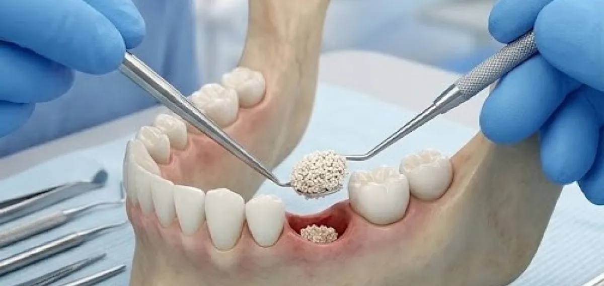 Bone Grafting - Oral Surgery Treatments at Dentique Dental Care