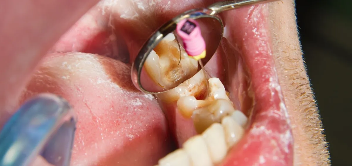 Gum Disease Treatment - General & Family Dentistry at Dentique Dental Care